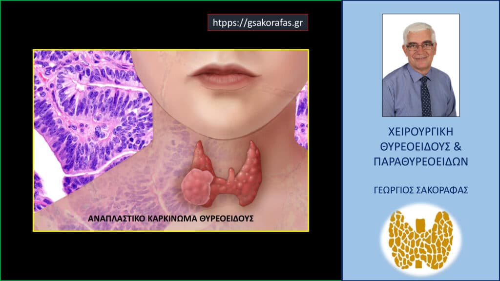 Home Αναπλαστικός καρκίνος θυρεοειδούς και μεταστατική διήθηση ζωτικών παρακειμένων ανατομικών στοιχείων - πόσο συχνά είναι εφικτή η ριζική εκτομή;