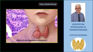 Αναπλαστικός καρκίνος θυρεοειδούς και μεταστατική διήθηση ζωτικών παρακειμένων ανατομικών στοιχείων - πόσο συχνά είναι εφικτή η ριζική εκτομή;