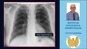 Γιγάντια καταδυόμενη βρογχοκήλη – διατραχηλική αφαίρεση (εικόνες, με αφορμή ασθενή μας) Σημαντική παρεκτόπιση της τραχείας (κόκκινο βέλος) προς τα δεξιά της μέσης γραμμής (μαύρη κάθετη διακεκομμένη γραμμή) από τον διογκωμένο καταδυόμενο αριστερό λοβό του θυρεοειδούς