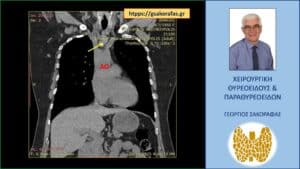 Όζος θυρεοειδούς πλήρως εξωφυτικός με βαθιά κατάδυση στο μεσοθωράκιο (κίτρινο βέλος). Εικόνα στην αξονική τομογραφία. Ο όζος φθάνει στις παρυφές του αορτικού τόξου (AO)