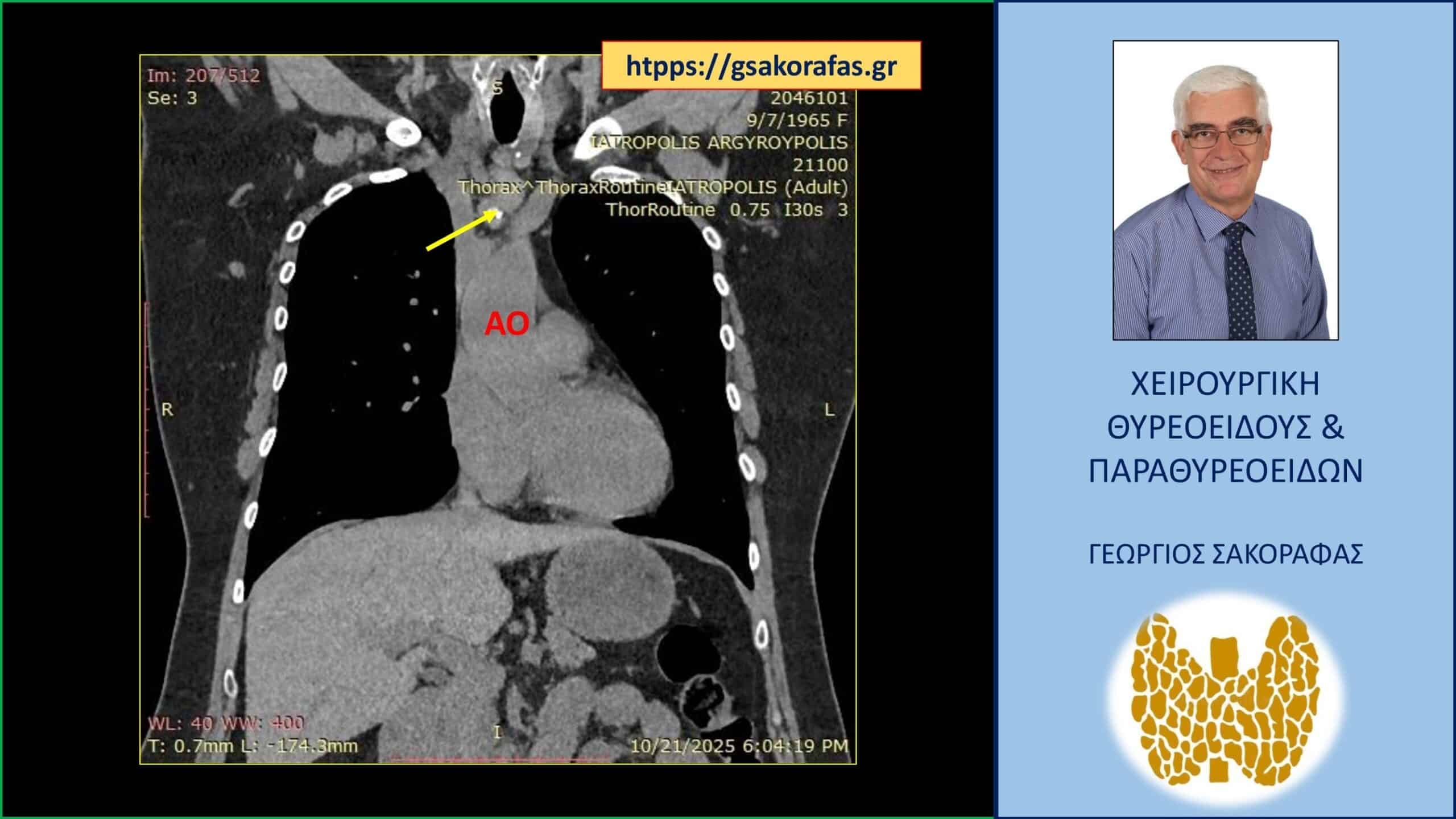 Όζος θυρεοειδούς πλήρως εξωφυτικός με βαθιά κατάδυση στο μεσοθωράκιο – αφαίρεση μέσω τραχηλικής τομής