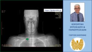 Τοπόγραμμα αξονικής τομογραφίας. Εμφανής η απώθηση της τραχείας (πράσινο βέλος) προς τα δεξιά της μέσης γραμμής (κάθετη μαύρη διακεκομμένη γραμμή)