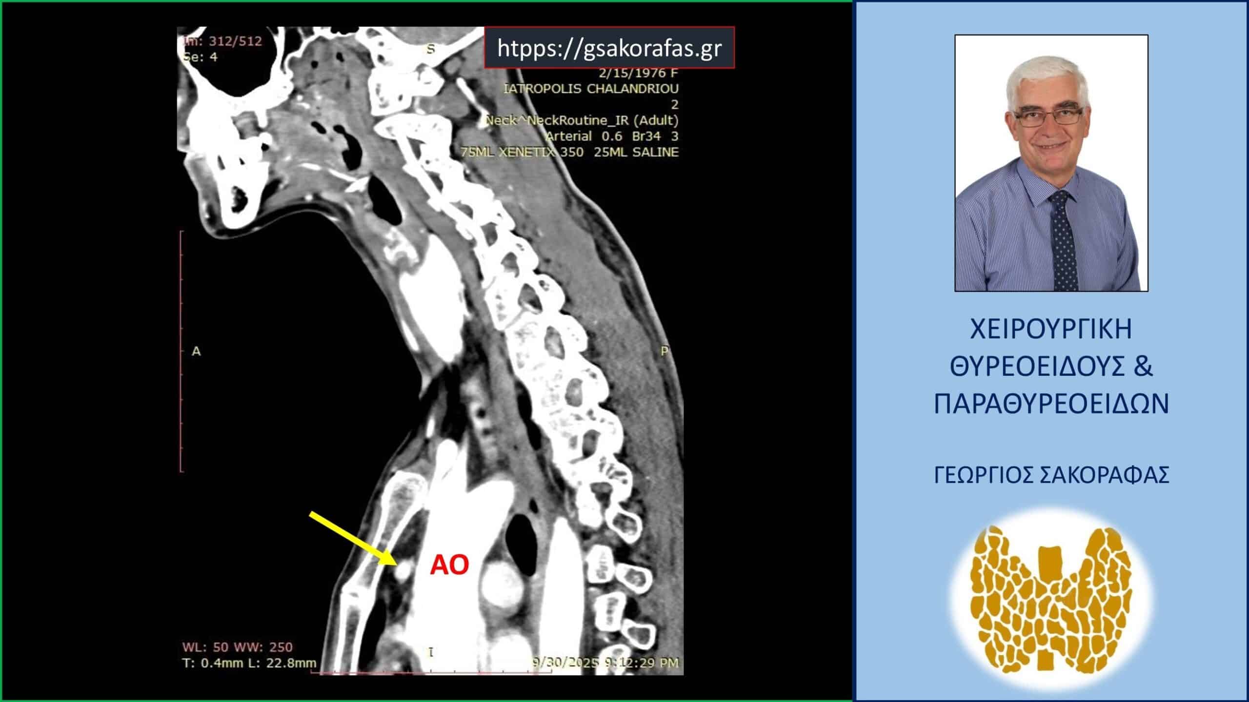 Ενδοθωρακικό αδένωμα παραθυρεοειδούς (έκτοπο) σε ασθενή μας με επιμένοντα πρωτοπαθή υπερπαραθυρεοειδισμό
