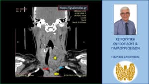 Αξονική τομογραφία -διατομή σε κατά μέτωπο επίπεδο. Ο ευμεγέθης όζος (κίτρινος αστερίσκος) εκτείνεται μεταξύ της έκφυσης της αριστερής κοινής καρωτίδας (μπλε βέλος) και του βραχιονοκεφαλικού στελέχους (κόκκινο βέλος), φθάνοντας σε βάθος στις παρυφές του αορτικού τόξου (κίτρινο βέλος).