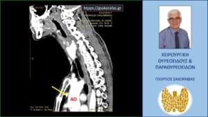 Ανάλογη με την προηγούμενη εικόνα και πάλι στην αξονική τομογραφία σε προσθιοπίσθια διατομή. Το ενδοθωρακικό αδένωμα (κίτρινο βέλος) έμπροσθεν της αορτής (ΑΟ).