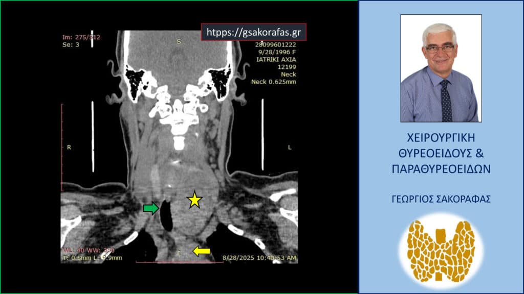 Home Ευμεγέθης όζος θυρεοειδούς. Αξονική τομογραφία – διατομή σε κατά μέτωπο επίπεδο (διαφορετικό από το προηγούμενο). Ο όζος (κίτρινος αστερίσκος) καταδύεται στο μεσοθωράκιο σε βάθος, φθάνοντας στις παρυφές του αορτικού τόξου (κίτρινο βέλος) και απωθεί προς τα δεξιά την τραχεία (πράσινο βέλος).