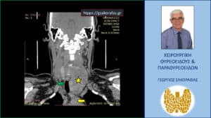 Ευμεγέθης όζος θυρεοειδούς. Αξονική τομογραφία – διατομή σε κατά μέτωπο επίπεδο (διαφορετικό από το προηγούμενο). Ο όζος (κίτρινος αστερίσκος) καταδύεται στο μεσοθωράκιο σε βάθος, φθάνοντας στις παρυφές του αορτικού τόξου (κίτρινο βέλος) και απωθεί προς τα δεξιά την τραχεία (πράσινο βέλος).