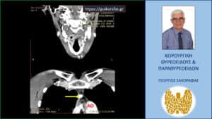 Αξονική τομογραφία – κατά μέτωπον διατομή όπου φαίνεται το έκτοπο ενδοθωρακικό αδένωμα (κίτρινο βέλος). ΑΟ=η κατιούσα αορτή. Η ανιούσα αορτή δεν απεικονίζεται στην διατομή αυτή καθώς βρίσκεται πιο πίσω από το αδένωμα.