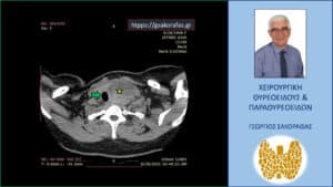 Αξονική τομογραφία – εγκάρσια διατομή. Ο ευμεγέθης όζος (κίτρινος αστερίσκος) απωθεί προς τα δεξιά την τραχεία (πράσινο βέλος).