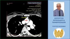Το έκτοπο ενδοθωρακικό αδένωμα παραθυρεοειδούς (κίτρινο βέλος) μέσα στον θώρακα, πίσω από το στέρνο, έμπροσθεν της ανιούσης αορτής (ΑΟ)