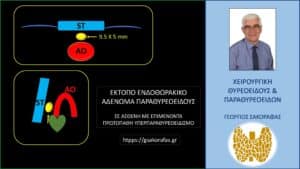 Σχηματική απεικόνιση του έκτοπου ενδοθωρακικού αδενώματος παραθυρεοειδούς (κίτρινο βέλος) – πίσω από το στέρνο, περίπου στο ύψος της μεσότητας της ανιούσης αορτής (ΑΟ), λίγο πάνω από την έκφυσή της από την καρδιά.