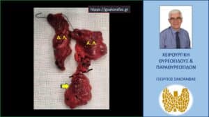 Χειρουργικό παρασκεύασμα. ΔΛ = ο δεξιός λοβός του θυρεοειδούς, ΑΛ = ο αριστερός λοβός του θυρεοειδούς. Ο πλήρως εξωφυτικός καταδυόμενος όζος (κίτρινο βέλος). Με την διακεκομμένη μαύρη γραμμή αποδίδεται σχηματικά η θέση της αριστερής κλείδας (καταδυόμενος όζος)