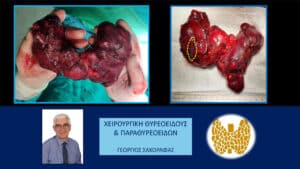 Γιγάντια καταδυόμενη βρογχοκήλη – διατραχηλική αφαίρεση (εικόνες, με αφορμή ασθενή μας) Γιγάντια καταδυόμενη βρογχοκήλη – χειρουργικό παρασκεύασμα. Εμφανής η μεγάλου βαθμού διόγκωση του θυρεοειδούς (στη σύγκριση με το μέγεθος των χεριών του χειρουργού). Στον πάνω δεξιά εικόνα με το κίτρινο περίγραμμα αποδίδεται το κατ΄ εκτίμηση μέγεθος ενός φυσιολογικού λοβού του θυροειδούς.