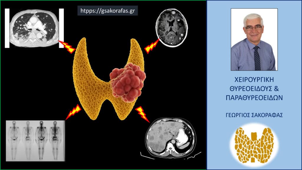 Home Καρκίνος θυρεοειδούς και μεταστάσεις σε μακρινά όργανα – πώς επηρεάζεται η πρόγνωση?