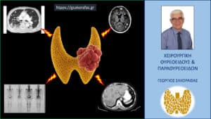 Καρκίνος θυρεοειδούς και μεταστάσεις σε μακρινά όργανα – πώς επηρεάζεται η πρόγνωση?