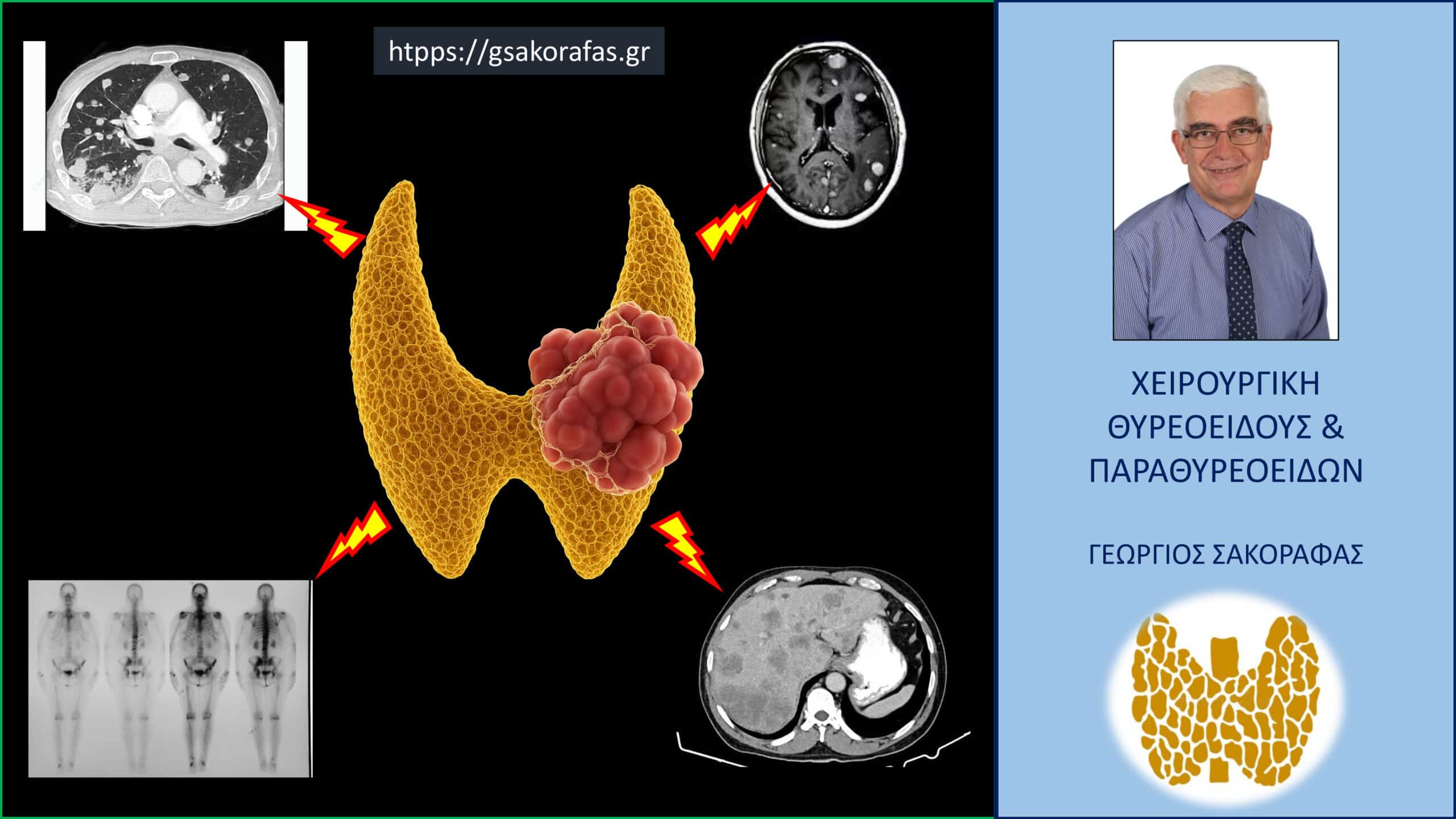 Καρκίνος θυρεοειδούς και μεταστάσεις σε μακρινά όργανα – πώς επηρεάζεται η πρόγνωση?