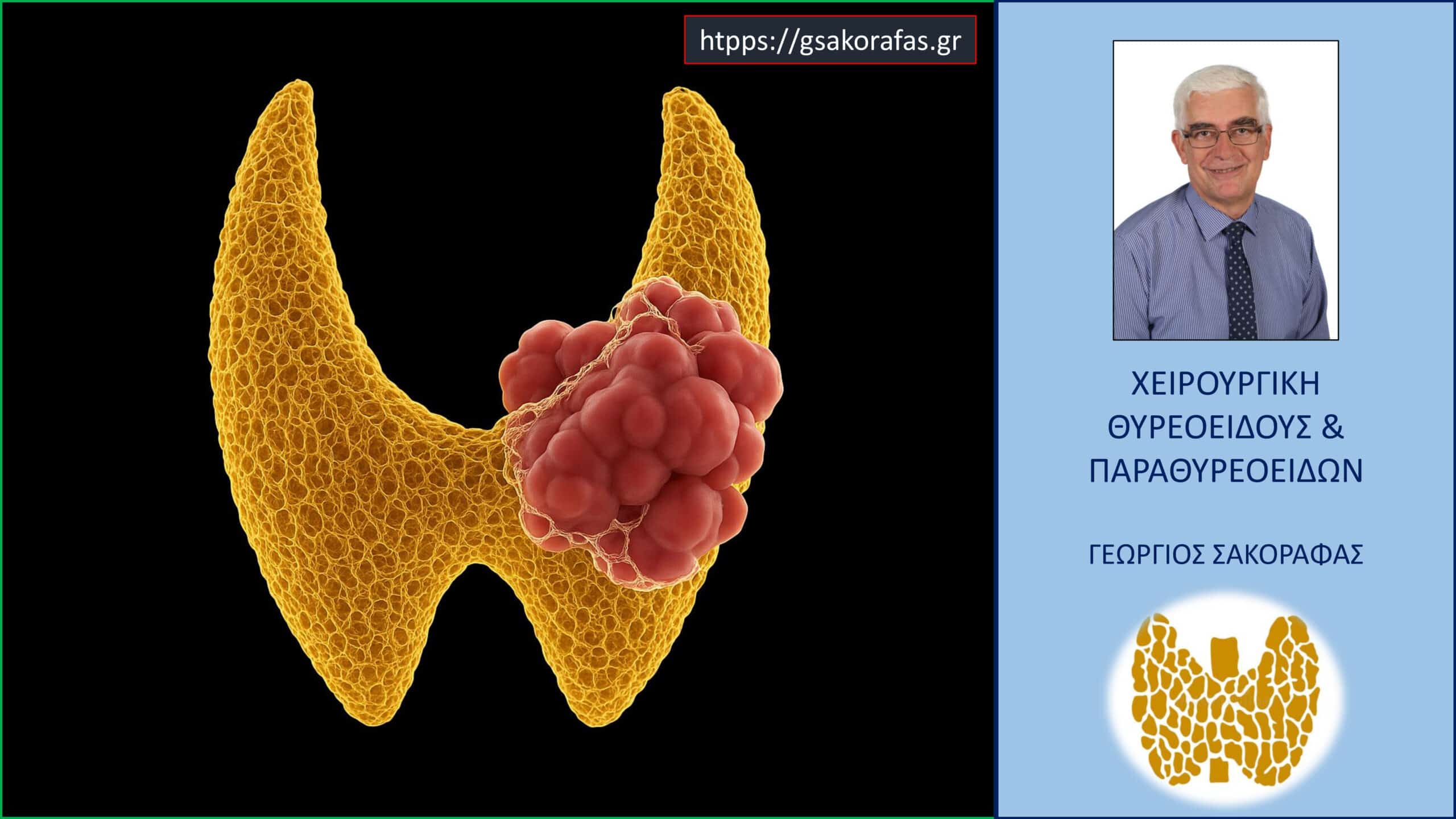Όζοι θυρεοειδούς – ένα συχνό πρόβλημα, συχνά αθώο, που όμως δεν μπορεί να αγνοηθεί