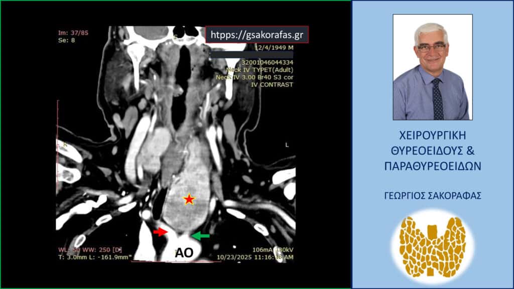 Home Γιγάντια καταδυόμενη βρογχοκήλη σε ασθενή με «δύσκολο» τράχηλο και βαθιά κατάδυση (μέχρι το αορτικό τόξο) – διατραχηλική εκτομή (χωρίς στερνοτομή) με ταυτόχρονη παραθυρεοειδεκτομή για τυχαία διαγνωσθέν αδένωμα παραθυρεοειδούς. Αξονική τομογραφία – εικόνα σε κατά μέτωπο διατομή: Ο καταδυόμενος αριστερός λοβός (κόκκινος αστερίσκος) εκτείνεται σε βάθος στο μεσοθωράκιο φθάνοντας στο άνω όριο του αορτικού τόξου (ΑΟ) μεταξύ της έκφυσης της ανωνύμου αρτηρίας (κόκκινο βέλος) και της αριστεράς κοινής καρωτίδας (πράσινο βέλος).