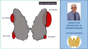Σχηματική αναπαράσταση των υπερηχογραφικών ευρημάτων στον ασθενή μας. Με το κόκκινο αποδίδονται οι διογκωμένοι υπερπλαστικοί παραθυρεοειδείς αδένες