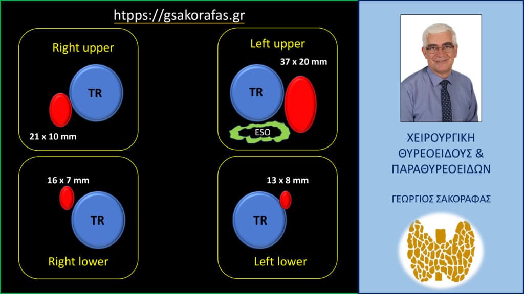 Home Τριτοπαθής υπερπαραθυρεοειδισμός -σχηματική αναπαράσταση των δεδομένων του υπερηχογραφήματος σε εγκάρσια διατομή TR= τραχεία, ESO=οισοφάγος