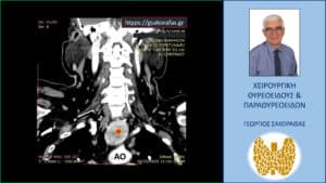 Αξονική τομογραφία – κατά μέτωπο διατομή , σε άλλο επίπεδο. Η εγγύτητα του καταδυόμενου αριστερού λοβού (κόκκινος αστερίσκος) με το αορτικό τόξο (ΑΟ) είναι εμφανής.