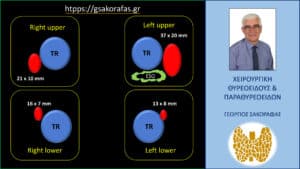 Τριτοπαθής υπερπαραθυρεοειδισμός -σχηματική αναπαράσταση των δεδομένων του υπερηχογραφήματος σε εγκάρσια διατομή TR= τραχεία, ESO=οισοφάγος