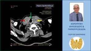 Αξονική τομογραφία – εγκάρσια διατομή στο ύψος του τραχήλου. Απεικονίζονται οι δύο διογκωμένοι λοβοί του θυρεοειδούς, αριστερός (κόκκινο βέλος) και δεξιός (κίτρινο βέλος). Εμφανής η απώθηση της τραχείας (πράσινο βέλος) προς τα δεξιά της μέσης γραμμής.