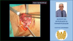 Στην εικόνα αυτή φαίνεται ο μεγαλύτερος υπερπλαστικός παραθυρεοειδής αδένας (αριστερά άνω) μετά την πλήρη του κινητοποίηση (τα όριά του επισημαίνονται με την διακεκομμένη γραμμή) TH = θυρεοειδής (αριστερός λοβός) 