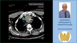Αξονική τομογραφία – εγκάρσια διατομή στο ύψος του θώρακα. Ο καταδυόμενος αριστερός λοβός σε βάθος στο μεσοθωράκιο (κίτρινο βέλος), απωθώντας την τραχεία (πράσινο βέλος) και τον οισοφάγο (μπλε βέλος ) προς τα δεξιά.