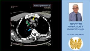 Αξονική τομογραφία – εγκάρσια διατομή στο ύψος του θώρακα, στο ύψος του αορτικού τόξου. Εμφανής η απώθηση της τραχείας (πράσινο βέλος) και του οισοφάγου (μπλε βέλος) προς τα δεξιά λόγω πίεσης από τον διογκωμένο αριστερό λοβό (κίτρινο βέλος).