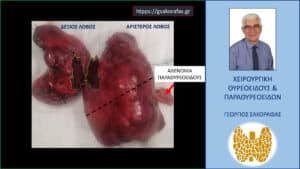 Χειρουργικό παρασκεύασμα. Δεξιός λοβός, αριστερός λοβός και το συναφαιρεθέν αδένωμα αριστερού κάτω παραθυρεοειδούς. Με την διακεκομμένη μαύρη γραμμή αποδίδεται σχηματικά η θέση της αριστερής κλείδας, με το μέρος του αριστερού λοβού  που βρίσκεται κάτω από την γραμμή αυτή να καταδύεται στο μεσοθωράκιο.