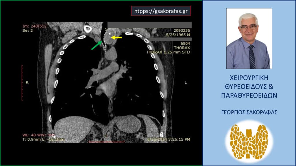 Home Ευμεγέθης καταδυόμενη βρογχοκήλη – απεικόνιση στην αξονική τομογραφία (σε κατά μέτωπο διατομή). Ο καταδυόμενος αριστερός λοβός του θυρεοειδούς (κίτρινο βέλος) φθάνει εγγύς στο αορτικό τόξο και απωθεί την τραχεία προς τα δεξιά (πράσινο βέλος) προκαλώντας στένωση του αυλού της.