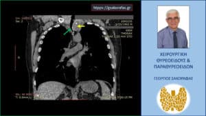 Ευμεγέθης καταδυόμενη βρογχοκήλη – απεικόνιση στην αξονική τομογραφία (σε κατά μέτωπο διατομή). Ο καταδυόμενος αριστερός λοβός του θυρεοειδούς (κίτρινο βέλος) φθάνει εγγύς στο αορτικό τόξο και απωθεί την τραχεία προς τα δεξιά (πράσινο βέλος) προκαλώντας στένωση του αυλού της.