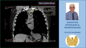 Απεικόνιση στην αξονική τομογραφία σε κατά μέτωπο διατομή (σε άλλο επίπεδο) όπου ο καταδυόμενος αριστερός λοβός του θυρεοειδούς (κίτρινο βέλος) φαίνεται να βρίσκεται μεταξύ της έκφυσης της αριστερής κοινής καρωτίδας και της ανωνύμου αρτηρίας από το αορτικό τόξο (ΑΟ).