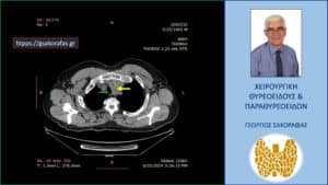 Αξονική τομογραφία – εγκάρσια διατομή στο ύψος περίπου των στερνοκλειδικών αρθρώσεων. Ο καταδυόμενος αριστερός λοβός (κίτρινο βέλος) απωθεί την τραχεία (πράσινο βέλος) προς τα δεξιά.