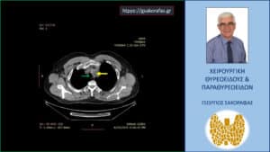 Αξονική τομογραφία – εγκάρσια διατομή σε χαμηλότερο επίπεδο σε σχέση με την προηγούμενη εικόνα. Ανάλογα ευρήματα.