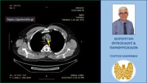 Αξονική τομογραφία – απεικόνιση σε εγκάρσια διατομή σε ένα αρκετά χαμηλό επίπεδο στον θώρακα. Το χαμηλότερο σημείο του καταδυόμενου αριστερού λοβού (κίτρινο βέλος) και η σχέση του με την τραχεία (πράσινο βέλος) και τον οισοφάγο (κόκκινο βέλος).