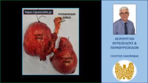 Χειρουργικό παρασκεύασμα – δεξιός λοβός, αριστερός λοβός, πυραμοειδής λοβός. Ο δεξιός λοβός βρίσκονταν στον τράχηλο, ενώ ο αριστερός σε χαμηλότερο επίπεδο, σε θέση κατάδυσης στο μεσοθωράκιο.