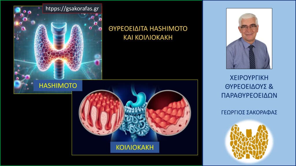 Home Θυρεοειδίτιδα Hashimoto και κοιλιοκάκη – 5 FAQs