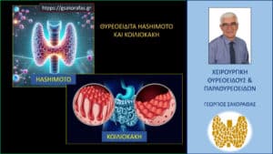 Θυρεοειδίτιδα Hashimoto και κοιλιοκάκη – 5 FAQs