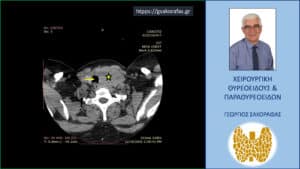 Καταδυόμενη βρογχοκήλη – εικόνες (με αφορμή ασθενή μας) Αξονική τομογραφία – εγκάρσια διατομή στο ύψος του τραχήλου. Ο ευμεγέθης όζος (κίτρινος αστερίσκος) που απωθεί την τραχεία προς τα αριστερά (κίτρινο βέλος).