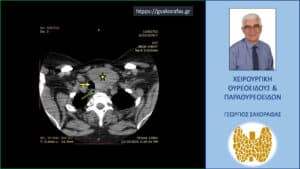 Καταδυόμενη βρογχοκήλη – εικόνες (με αφορμή ασθενή μας) Αξονική τομογραφία και πάλι στο ύψος του τραχήλου αλλά σε χαμηλότερο επίπεδο. Κίτρινος αστερίσκος – ο ευμεγέθης όζος, κίτρινο βέλος – η τραχεία και πάλι απωθούμενη προς τα δεξιά.