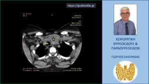Καταδυόμενη βρογχοκήλη – εικόνες (με αφορμή ασθενή μας) Αξονική τομογραφία – εγκάρσια διατομή σε ακόμη χαμηλότερο επίπεδο. Απεικονίζεται ο ευμεγέθης καταδυόμενος όζος (κίτρινος αστερίσκος) και η απώθηση προς τα δεξιά της τραχείας (κίτρινο βέλος) και του οισοφάγου (πράσινο βέλος).