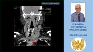Καταδυόμενη βρογχοκήλη – εικόνες (με αφορμή ασθενή μας) Καταδυόμενη βρογχοκήλη – αξονική τομογραφία σε κατά μέτωπο διατομή. Απεικονίζεται ο ευμεγέθης όζος (κίτρινος αστερίσκος) σε θέση κατάδυσης στο ανώτερο μεσοθωράκιο φθάνοντας στις παρυφές του αορτικού τόξου (κόκκινο βέλος) ανάμεσα από την έκφυση της ανωνύμου αρτηρίας και της αριστερής υποκλειδίου αρτηρίας, απωθώντας προς τα δεξιά την τραχεία (κίτρινο βέλος).