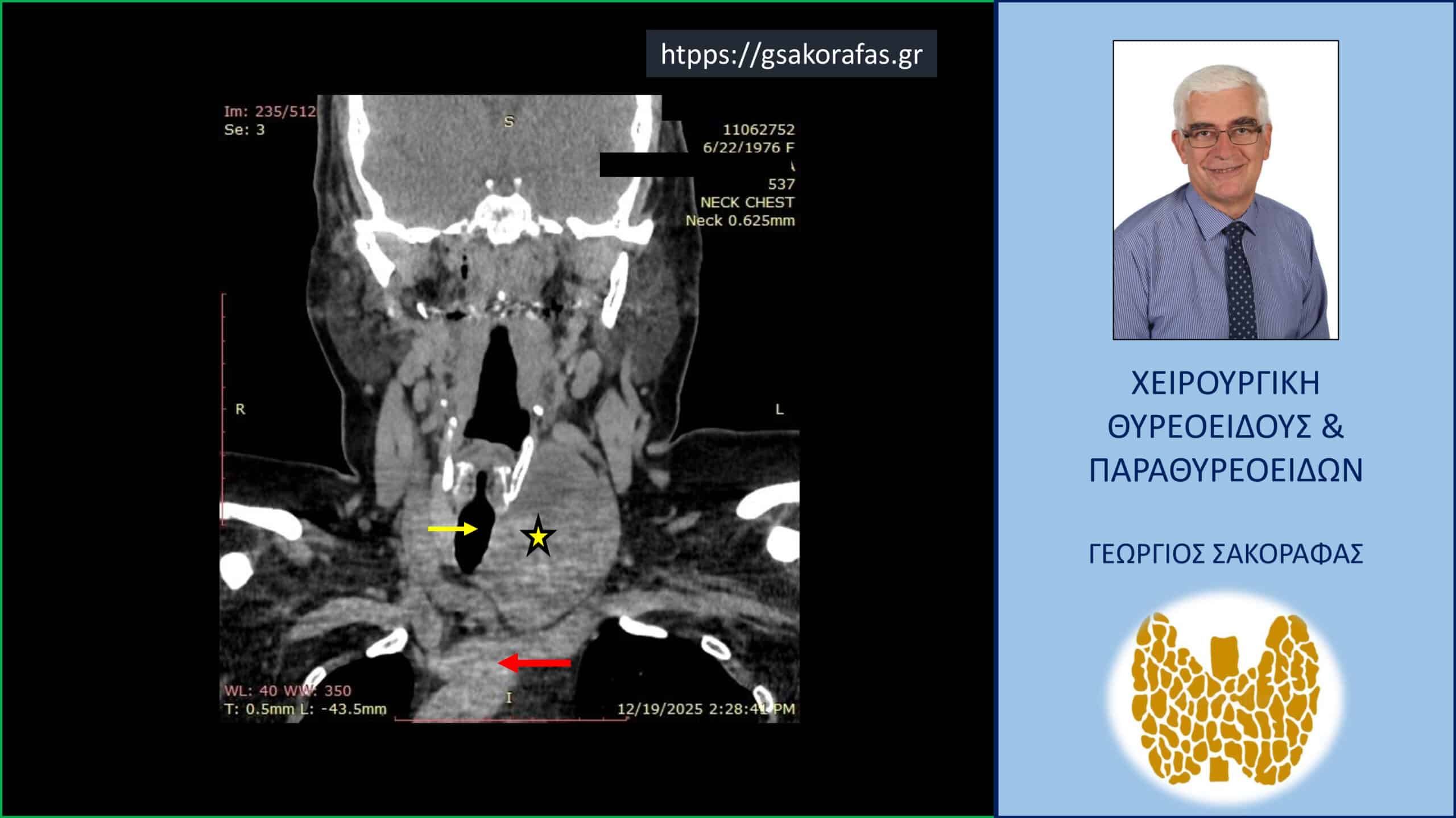 Καταδυόμενη βρογχοκήλη – εικόνες (με αφορμή ασθενή μας)