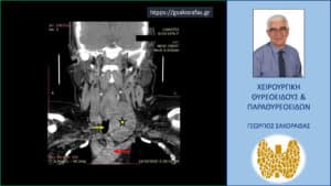Καταδυόμενη βρογχοκήλη – εικόνες (με αφορμή ασθενή μας) Αξονική τομογραφία – κατά μέτωπο διατομή σε άλλο επίπεδο. Ευρήματα ανάλογα με αυτά που περιγράφονται στην προηγούμενη εικόνα (κίτρινος αστερίσκος ο καταδυόμενος όζος, κόκκινο βέλος το αορτικό τόξο, κίτρινο βέλος η τραχεία).