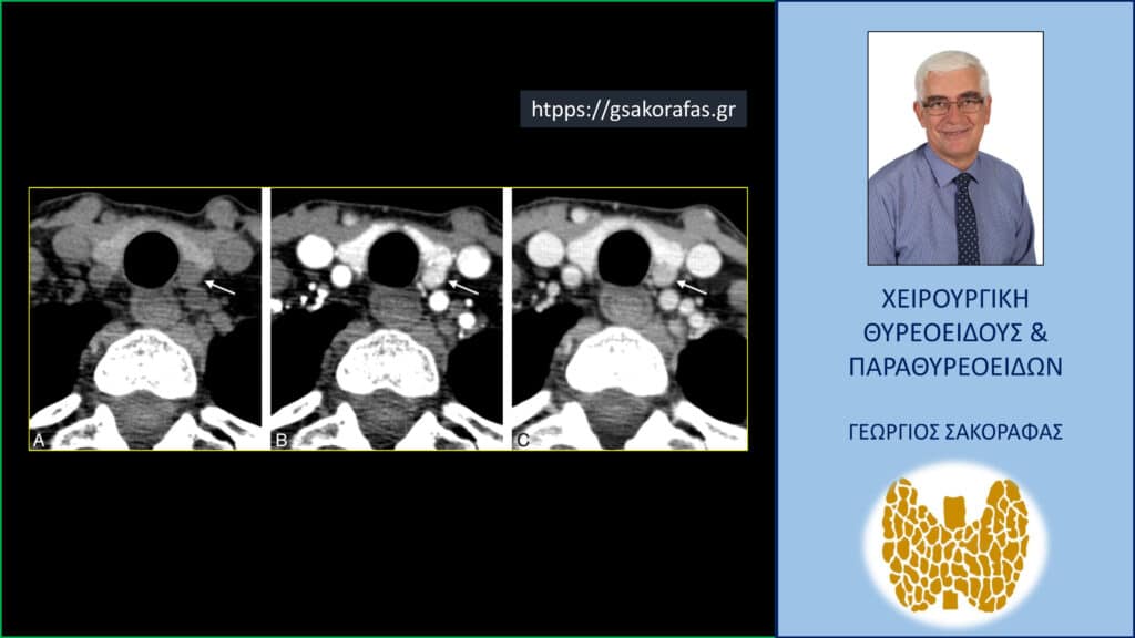 Πρωτοπαθής υπερπαραθυρεοειδισμός και τετραδιάστατη αξονική τομογραφία (four-dimensional computed tomography [4D-CT])
