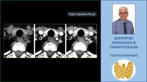Πρωτοπαθής υπερπαραθυρεοειδισμός και τετραδιάστατη αξονική τομογραφία (four-dimensional computed tomography [4D-CT])
