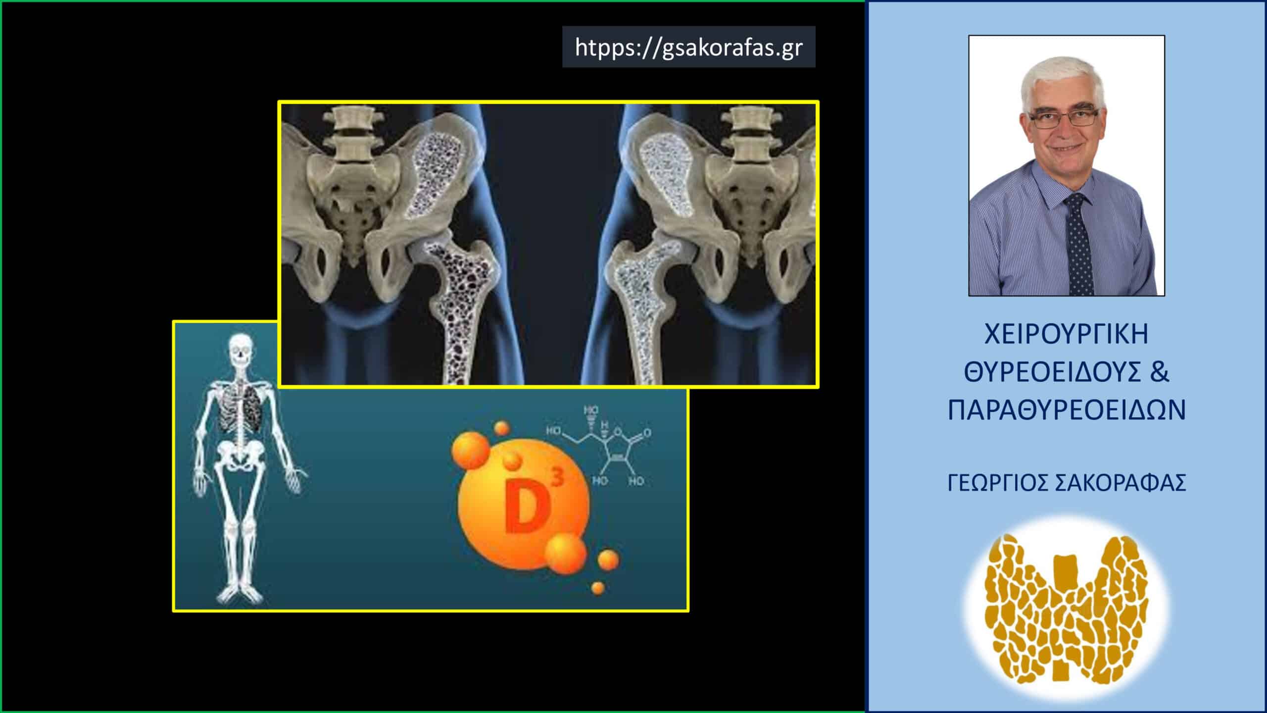 Παραθορμόνη και οστεοπόρωση – πως επηρεάζει η οστεοπόρωση τα επίπεδα παραθορμόνης στο αίμα?