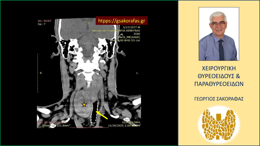 Home Καταδυόμενη βρογχοκήλη με πιεστικά φαινόμενα από την τραχεία – με αφορμή ασθενή μας (εικόνες)